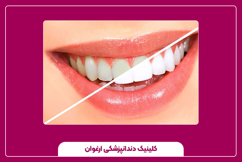 میزان سفیدی دندان با بلیچینگ دندان چقدر است؟