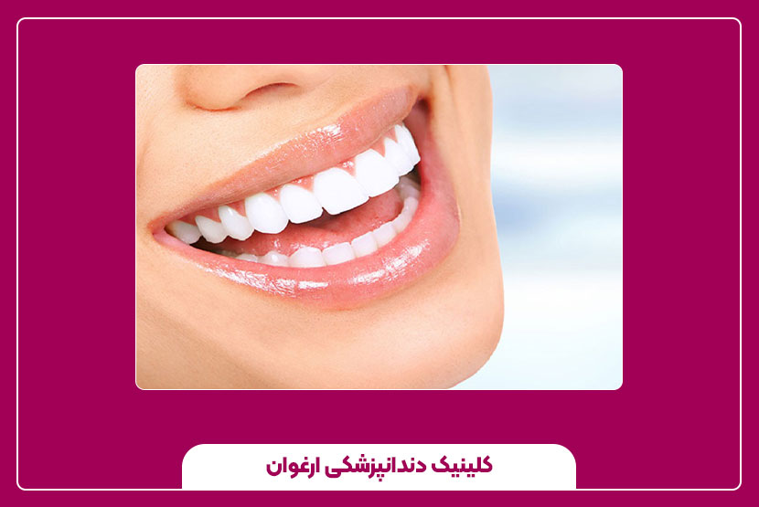 ماندگاری سفیدی دندان بعد از بلیچینگ چقدر است؟