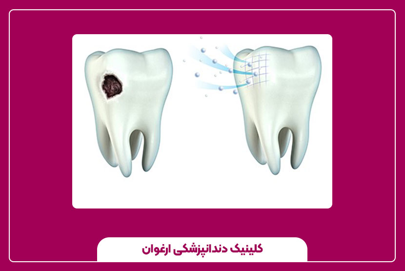 مزایا و معایب ترمیم دندان با مینای مصنوعی