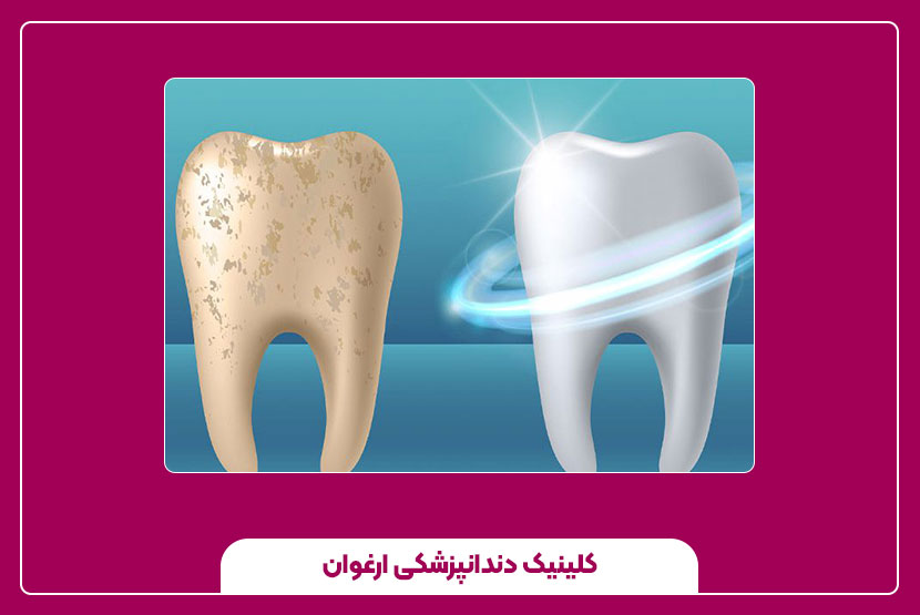 چه دندان‌هایی به ترمیم با مینای مصنوعی نیاز دارند؟