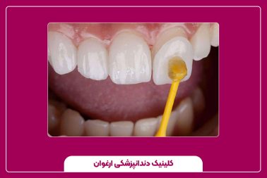 ترمیم دندان با مینای مصنوعی