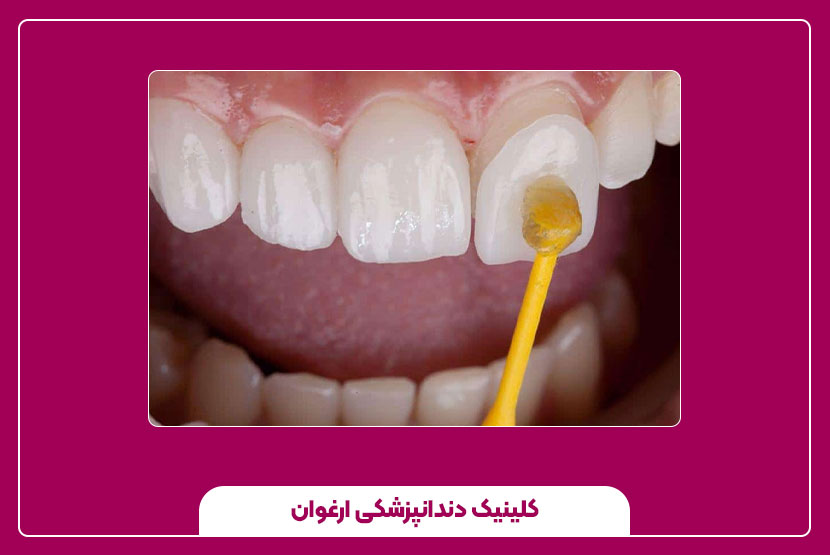 ترمیم دندان با مینای مصنوعی