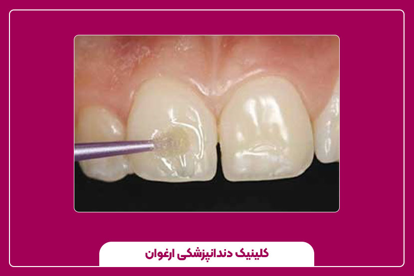 هزینه ترمیم دندان با مینای مصنوعی و عوامل تأثیرگذار بر آن