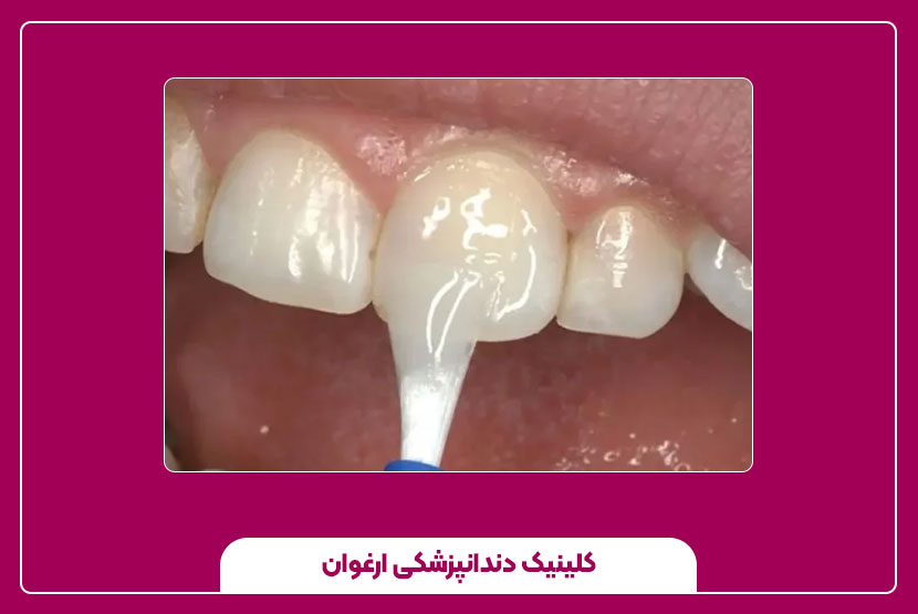 مینای مصنوعی دندان چگونه عمل می‌کند؟