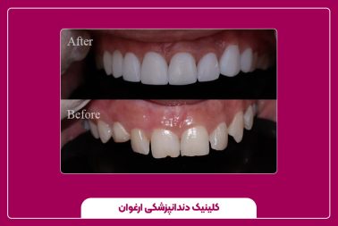 ترمیم دندان‌های لب‌پر یا شکسته