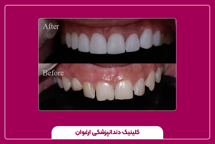 ترمیم دندان‌های لب‌پر یا شکسته