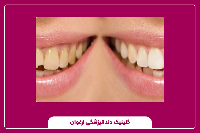 انواع شکستگی دندان: جزئی، کامل و ترک‌خورده