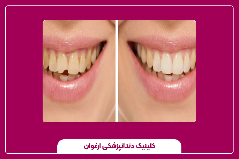 مراقبت‌های بعد از ترمیم دندان