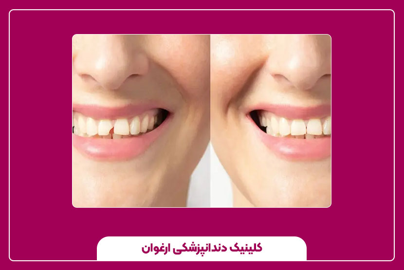 روش‌های ترمیم دندان شکسته