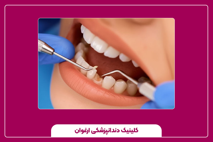 هزینه ترمیم دندان لب‌پر یا شکسته