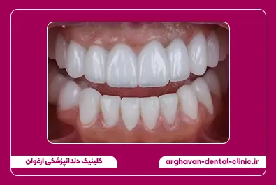 تعویض روکش بعد