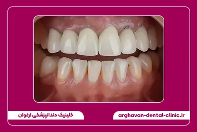 تعویض روکش قبل