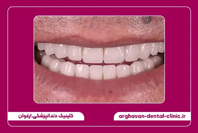 تعویض روکش بعد