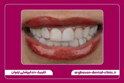 تعویض کامپوزیت قبل