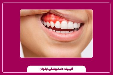 جراحی لثه برای درمان تحلیل لثه