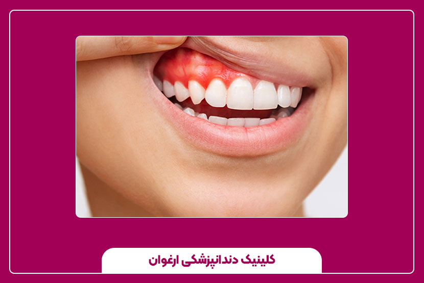 جراحی لثه برای درمان تحلیل لثه