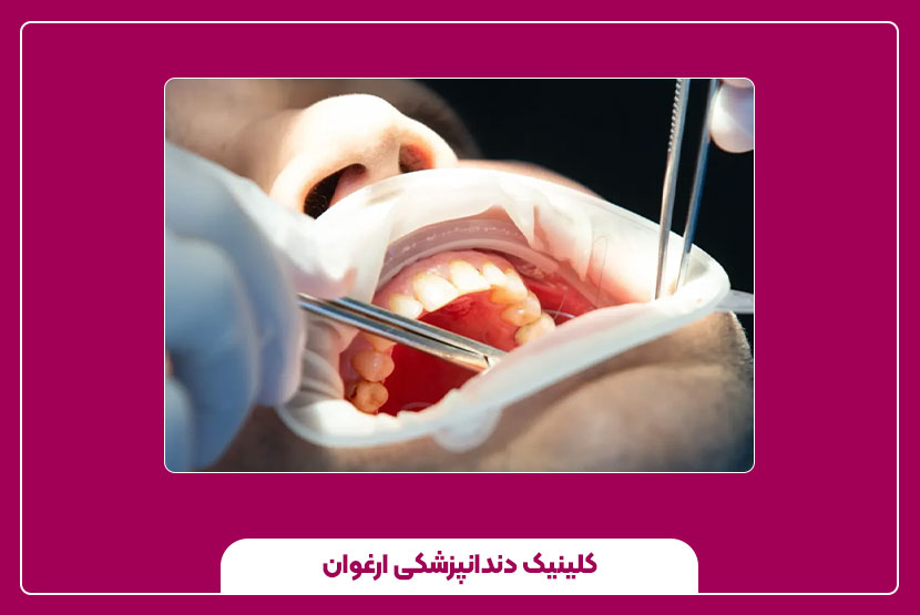 مراقبت‌های قبل و بعد از جراحی لثه