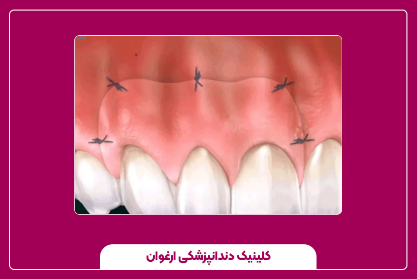 جراحی لثه چیست و چگونه انجام می‌شود؟