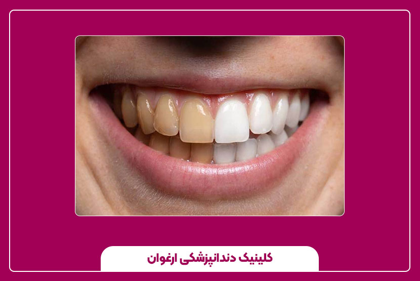 چه افرادی باید زودتر از ۶ ماه جرم‌گیری انجام دهند؟