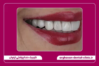 درمان ترکیبی روکش و کامپوزیت بعد