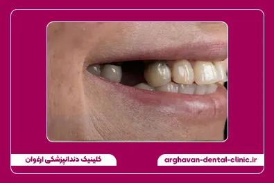 درمان ترکیبی روکش و کامپوزیت قبل