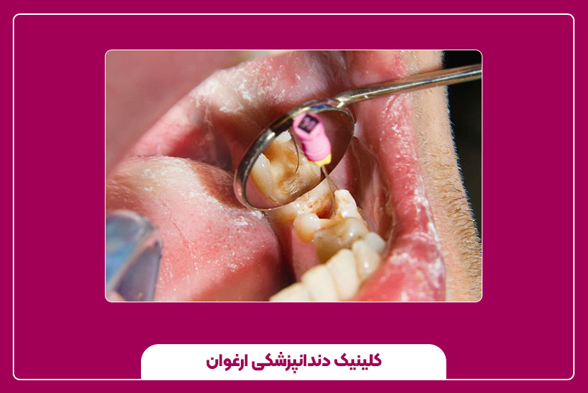 هزینه درمان ریشه چند کاناله دندان و عوامل تأثیرگذار بر آن