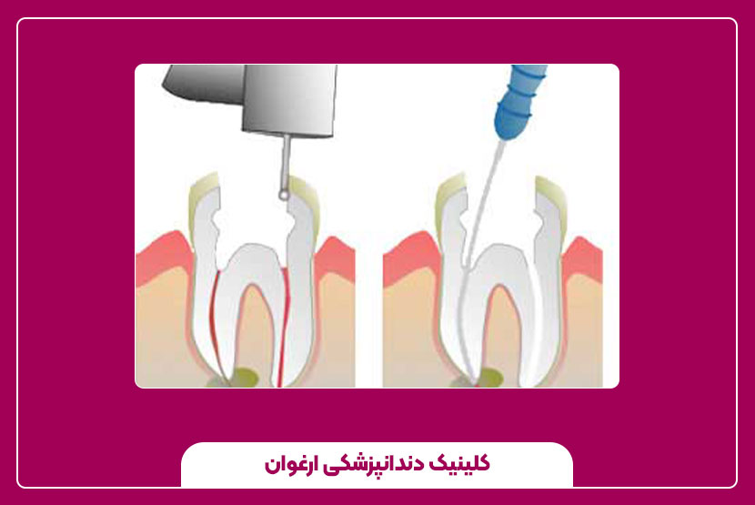 مدت زمان درمان ریشه چند کاناله چقدر است؟