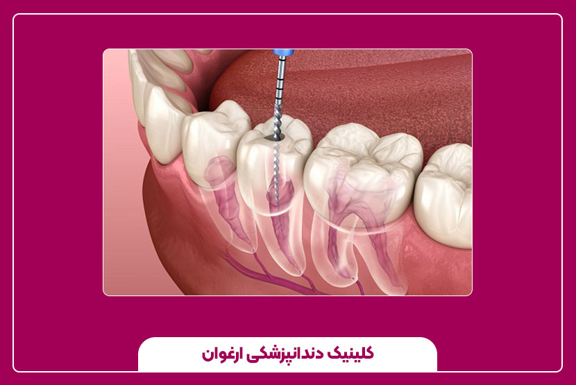 مراقبت‌های بعد از درمان ریشه چند کاناله