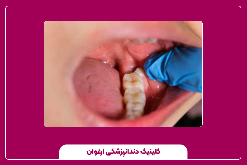 هزینه جراحی دندان نهفته و عوامل مؤثر بر قیمت