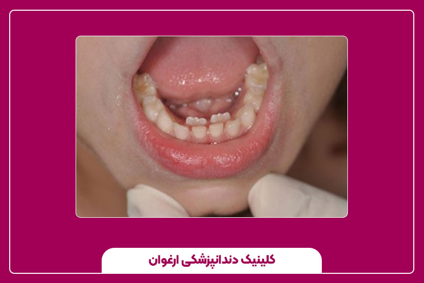 روش‌های درمان دندان نهفته: جراحی یا کشیدن دندان؟