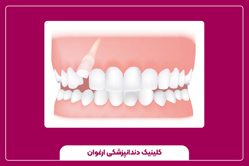 علائم و نشانه‌های دندان نهفته که نباید نادیده بگیرید