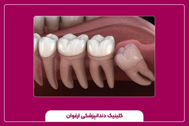دندان‌های نهفته: علل و روش‌های جراحی