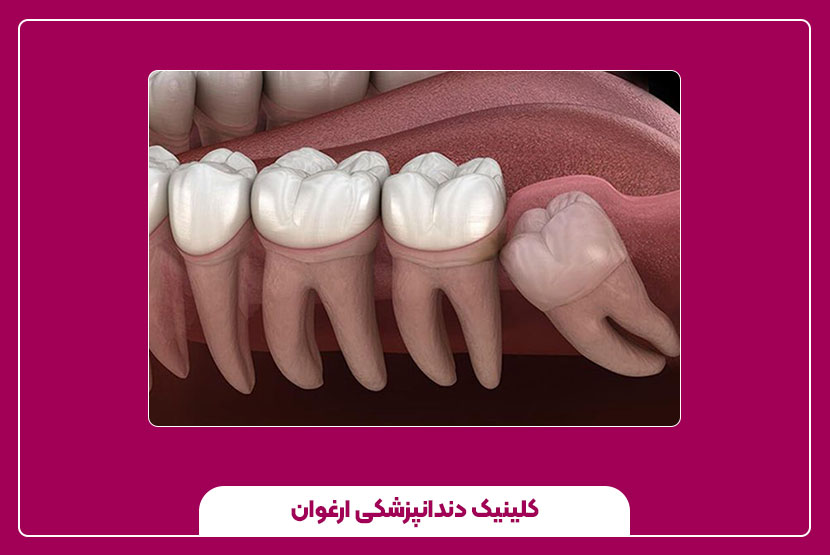 دندان‌های نهفته: علل و روش‌های جراحی