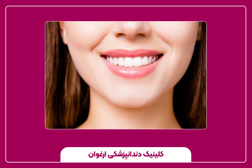 تفاوت ونیز کامپوزیت با لمینت سرامیکی