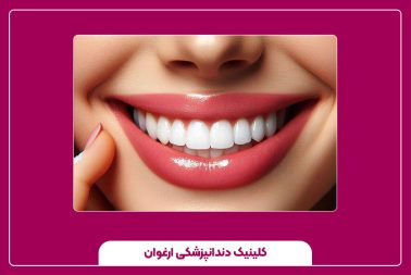 ماندگاری ونیز کامپوزیت چقدر است؟