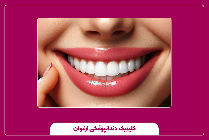 ماندگاری ونیز کامپوزیت چقدر است؟