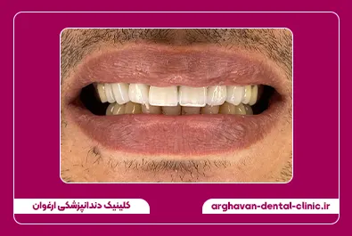 روکش زیرکونیوم بعد