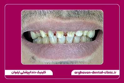 روکش زیرکونیوم قبل