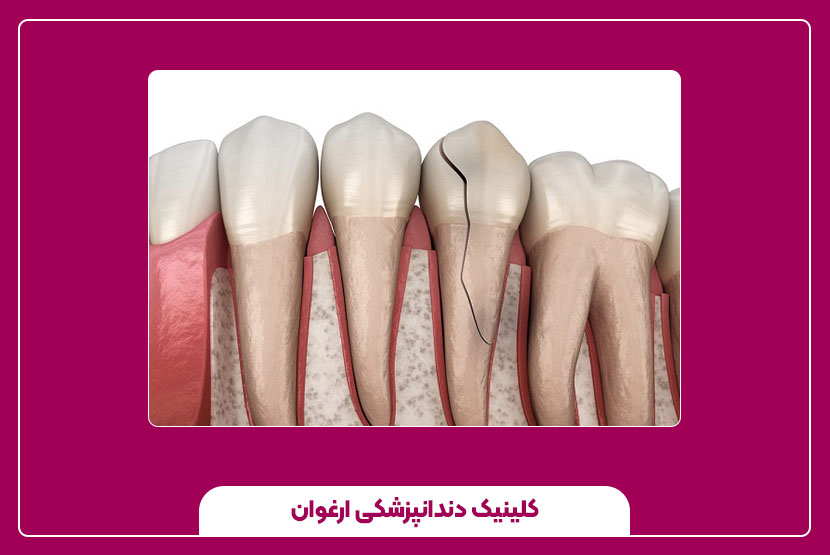 شکستگی مرتبط با درمان های دندان پزشکی