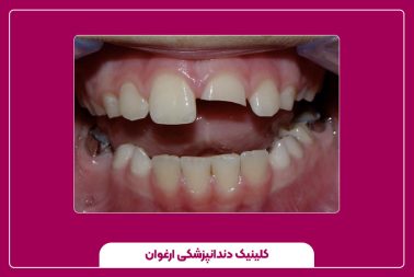 عوامل تاثیرگذار در شکستن دندان