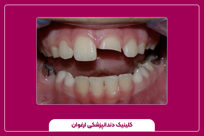 عوامل تاثیرگذار در شکستن دندان