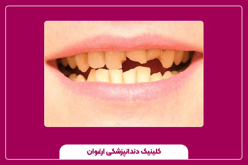 عوامل تغذیه ای و سبک زندگی بر سلامت دندان