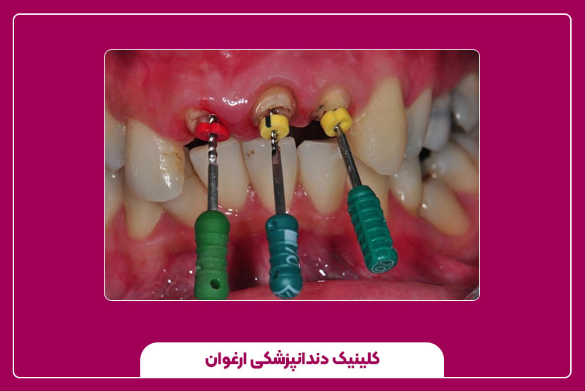 نگهداری و ترمیم پس از عصب‌ کشی دندان جلویی