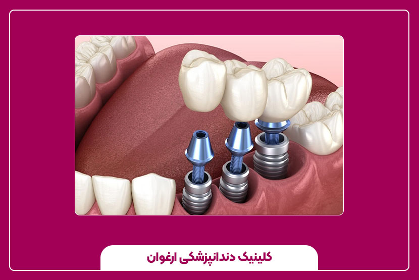 مراحل کاشت ایمپلنت دندان