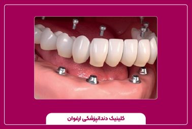 مراحل کاشت ایمپلنت دندان و روند درمان