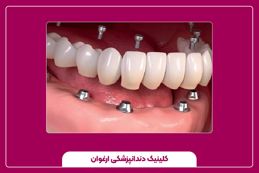 مراحل کاشت ایمپلنت دندان و روند درمان