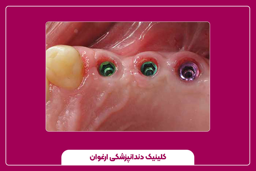روند درمان ایمپلنت دندان از ابتدا تا انتها