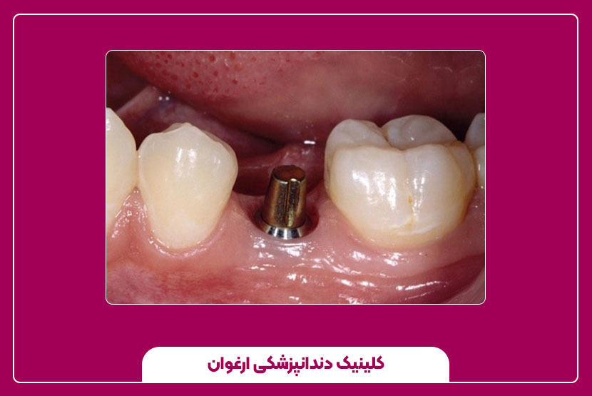 مراقبت‌های بعد از کاشت ایمپلنت دندان