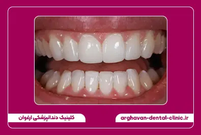 مرتب سازی دندان با کامپوزیت بعد