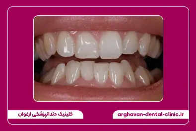 مرتب سازی دندان با کامپوزیت قبل